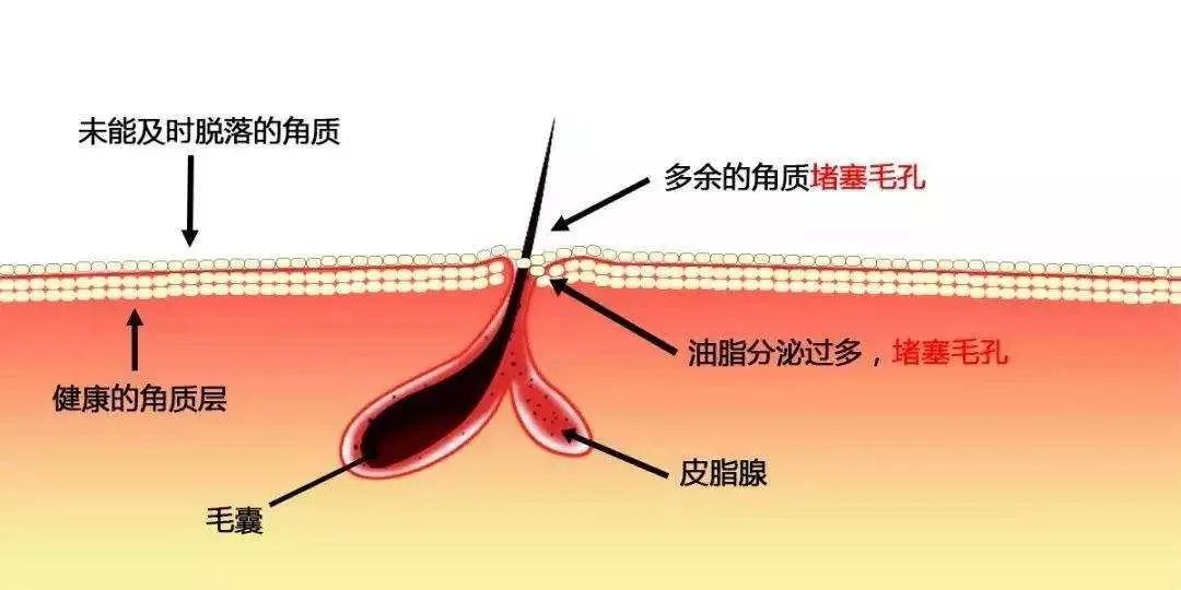 如何解救「大油田」？清爽男士必备的控油答案在此